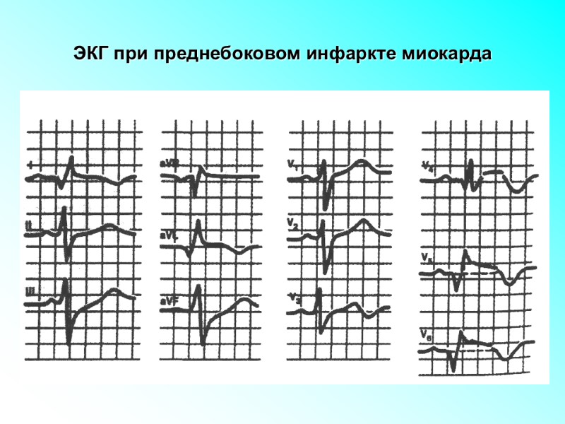 ЭКГ при преднебоковом инфаркте миокарда